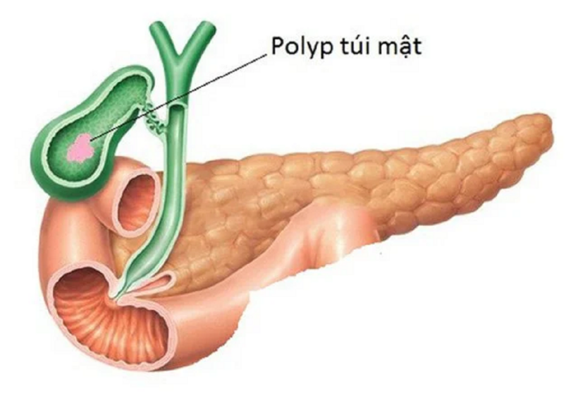 Mổ polyp túi mật chỉ được thực hiện khi polyp có nguy cơ tiến triển ác tính
