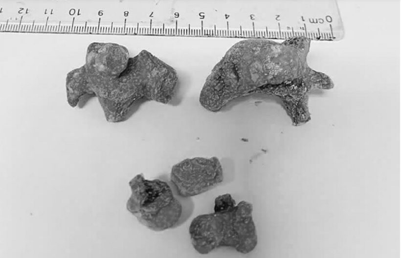 Khối sỏi san hô trong thận trái của bệnh nhân. Ảnh: VietNamNet.