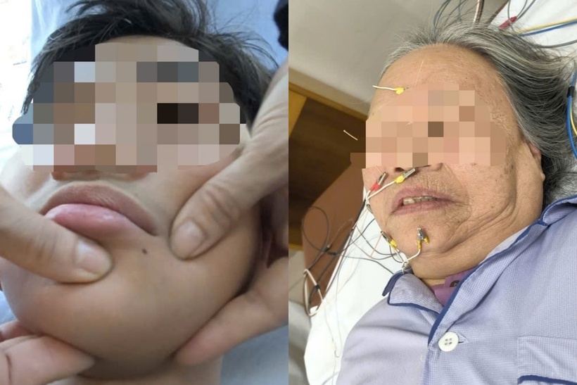 Rét đậm, nhiều người nhập viện vì méo miệng, lệch mặt