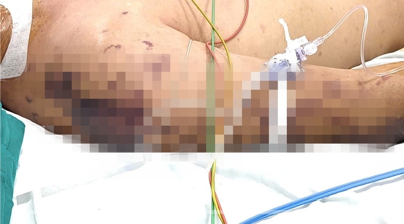 Căn bệnh nguy hiểm dễ nhầm lẫn với liên cầu lợn