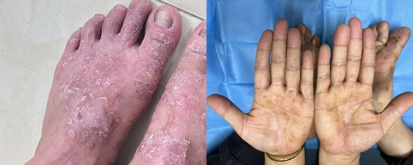 Viêm da cơ địa bùng phát vào mùa đông khiến số ca bệnh nhập viện tăng cao