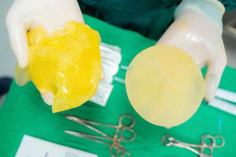 Nhiều người lo ngại “vỡ túi ngực” khi chơi pickleball