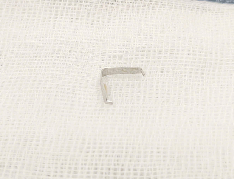 Ghim kim loại sắc nhọn mắc trong họng miệng