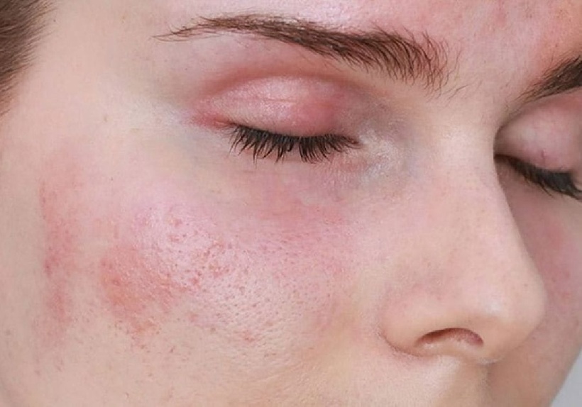 Ngứa da và nổi mẩn đỏ.