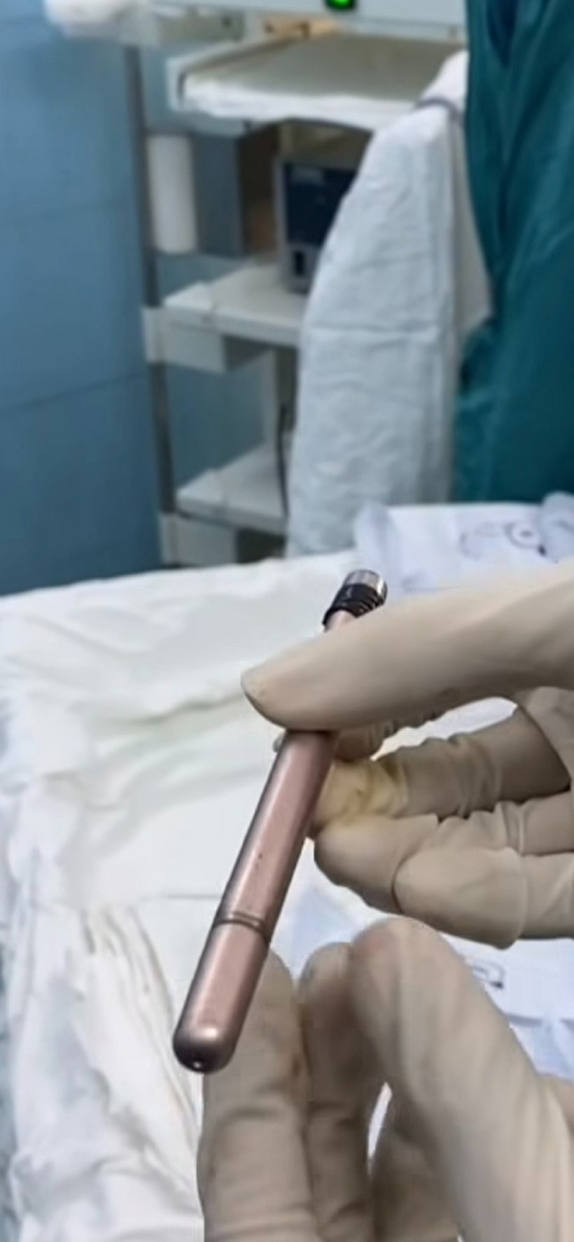 Hình ảnh cây bút được lấy ra từ bàng quang của bệnh nhân. Ảnh: Tuổi Trẻ.