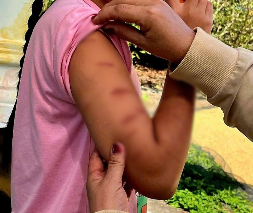 Hình ảnh vết thương trên người nữ sinh. Ảnh: Dân Việt