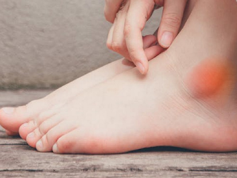 Nếu chức năng thận bị ảnh hưởng, chất lỏng có thể đọng lại ở mắt cá chân hoặc bàn chân, dẫn đến sưng nhẹ.