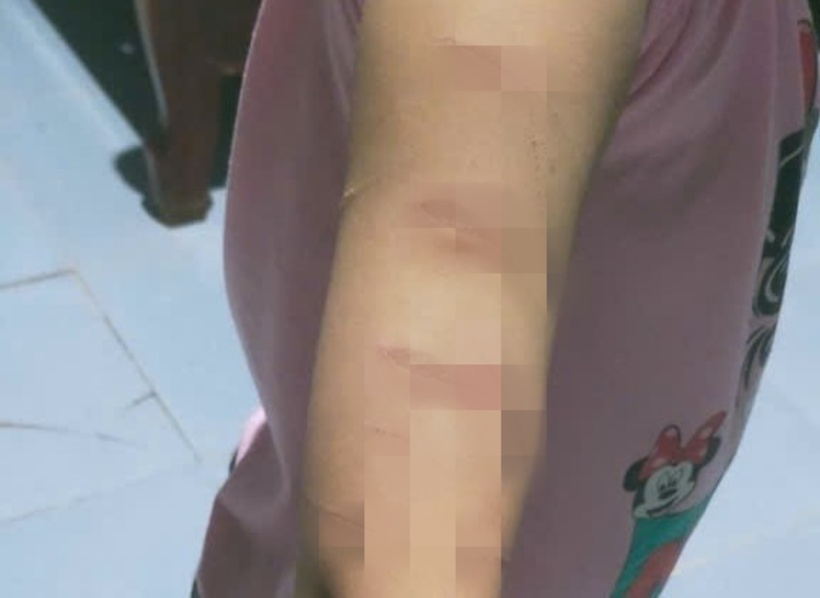 Vết thương của bé N. Ảnh: Tiền Phong.