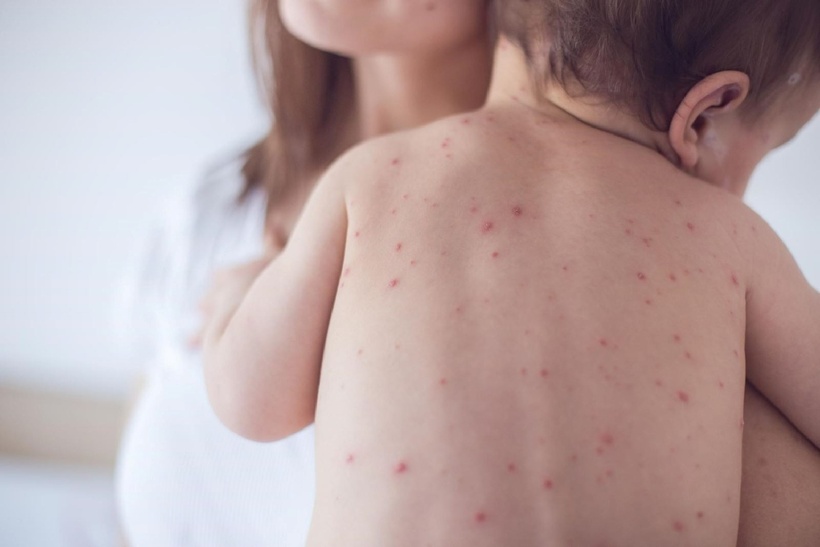 Thời tiết nồm ẩm chính là điều kiện thuận lợi để bệnh thủy đậu phát triển và lây lan nhanh chóng.