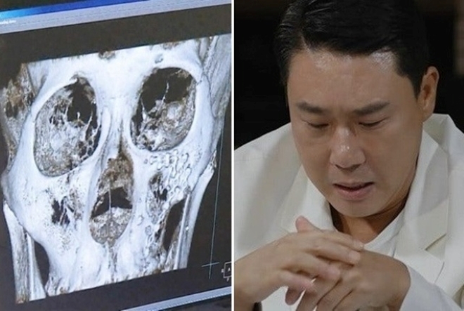 Hình ảnh chụp X-quang khuôn mặt của Lee Sang Min sau vụ ẩu đả trong quán nhậu đã khiến cả mạng xã hội xôn xao bàn tán. Ảnh: Nate