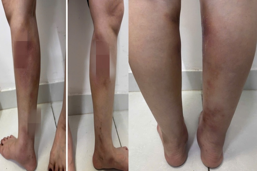 Biến dạng đôi chân sau khi tiêm filler làm thẳng chân tại nhà. Ảnh: Bệnh viện Bạch Mai.