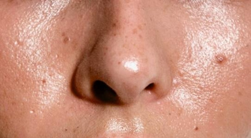 Khi mùa hè đến, nhiệt độ cao cùng khói bụi, ô nhiễm lại càng khiến da dầu tiết nhiều dầu hơn khiến việc kiểm soát dầu trở nên khó khăn. Ảnh minh họa.