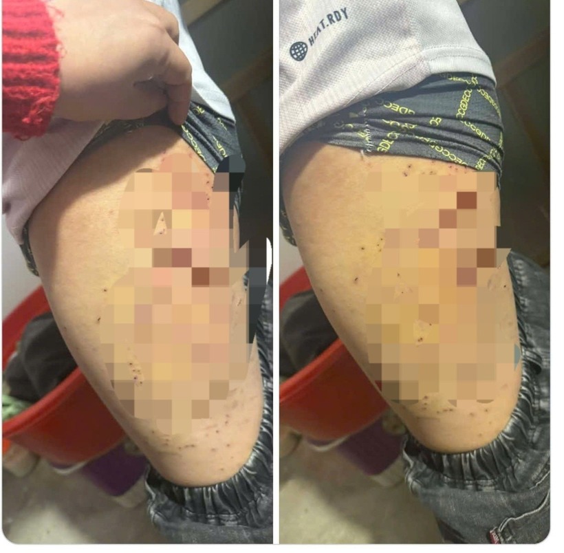 Chi chít vết đâm trên đùi học sinh T. Ảnh: Tiền phong