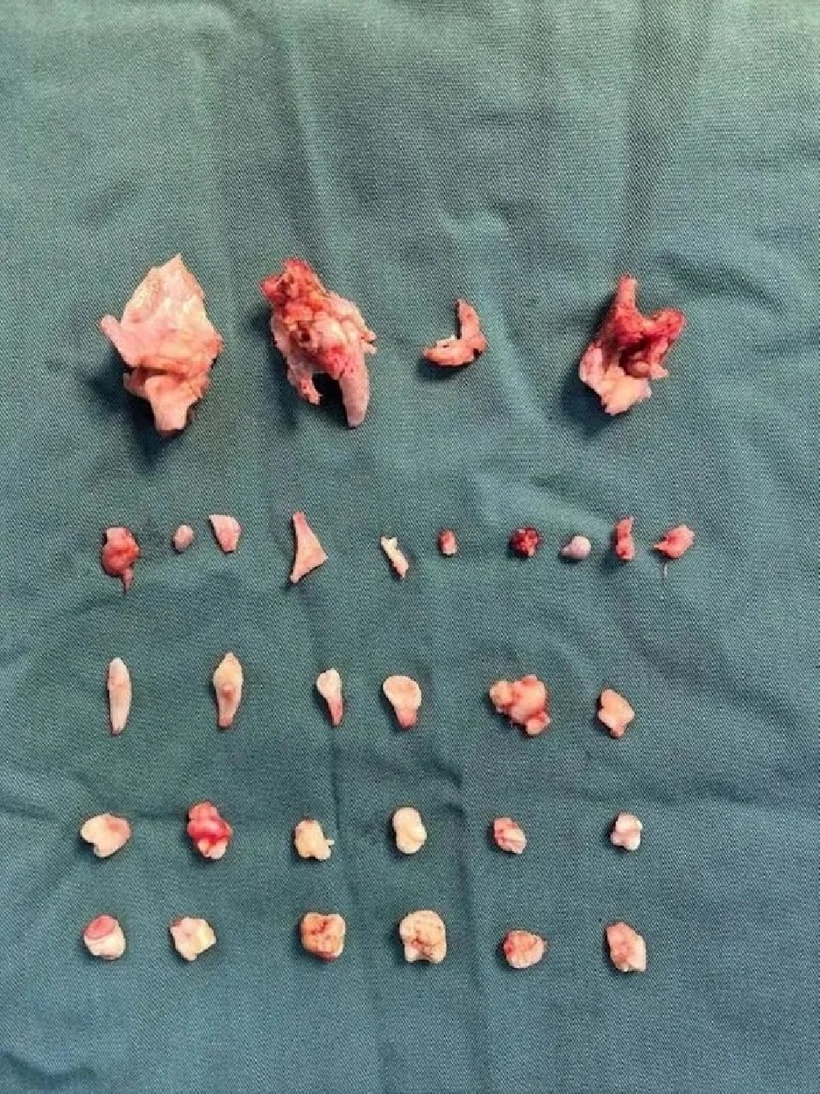 Các bác sĩ phát hiện bên trong khối u chứa tới 24 chiếc răng với nhiều hình dạng khác nhau, cùng các mô xương. Ảnh: Xiaoxiang Morning Post.