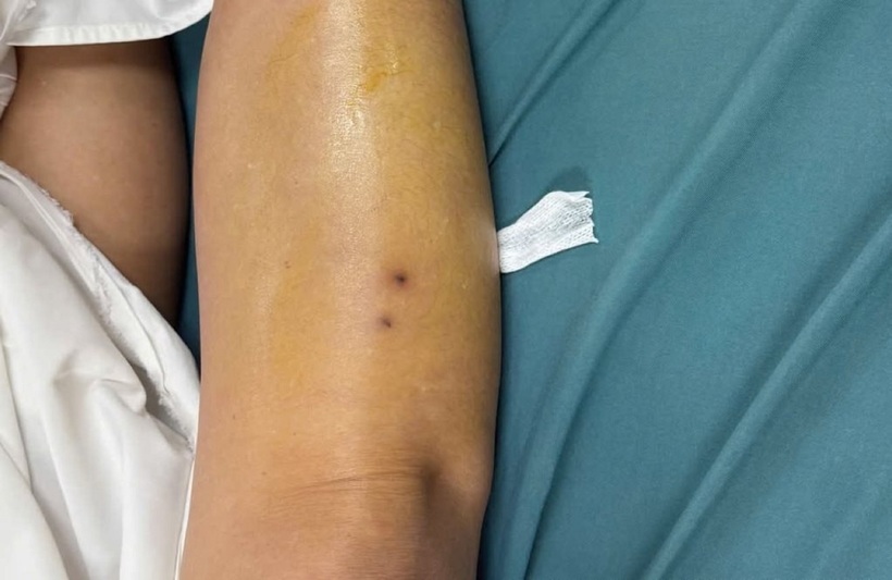 Vết cắn ở chân của bệnh nhân. Ảnh: Công lý.