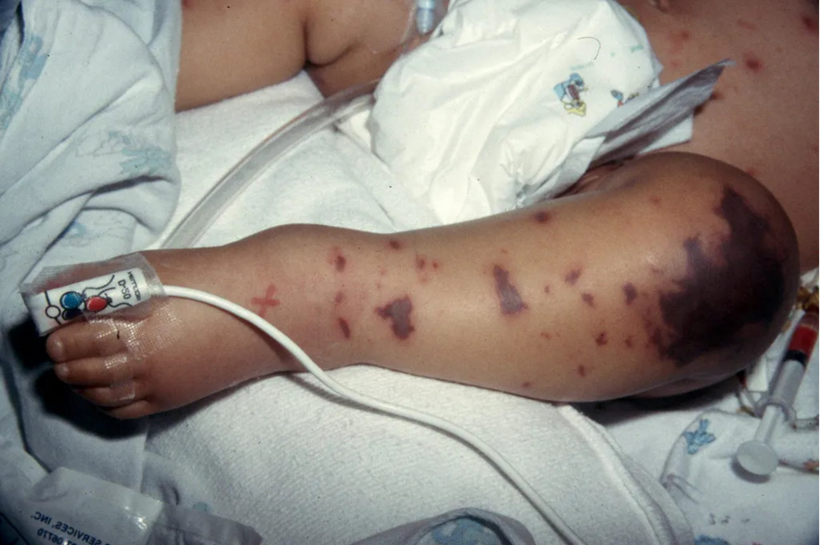Dấu hiệu tử ban trên da của bệnh nhi mắc não mô cầu. Ảnh: Meningitis Now