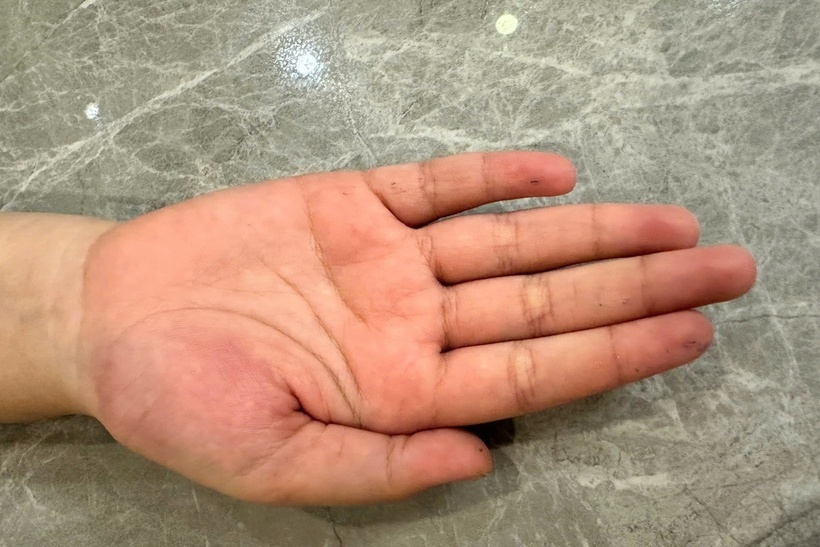 Tay của cháu T. có biểu hiện sưng tím vào tối 19/3. Ảnh: Phụ nữ Việt Nam