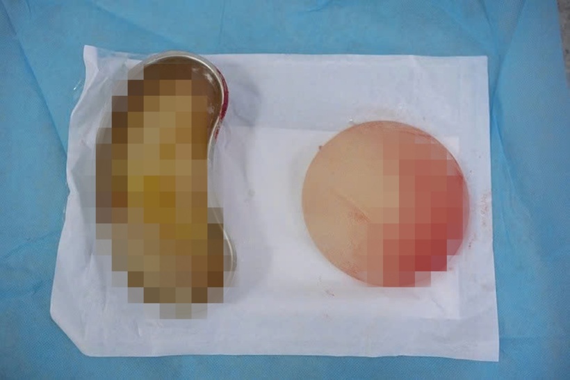 Túi độn vỡ nhưng không có triệu chứng rõ ràng