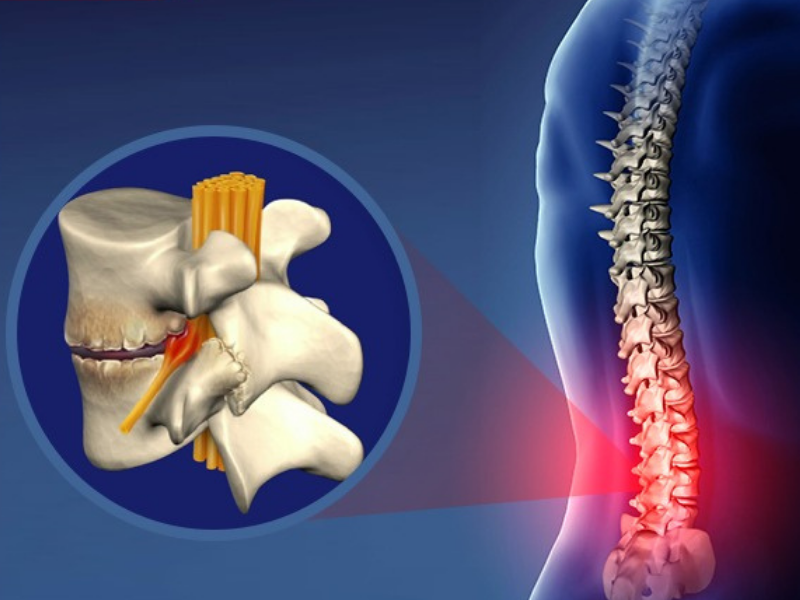 Gai cột sống thắt lưng gây đau lưng lan xuống chân