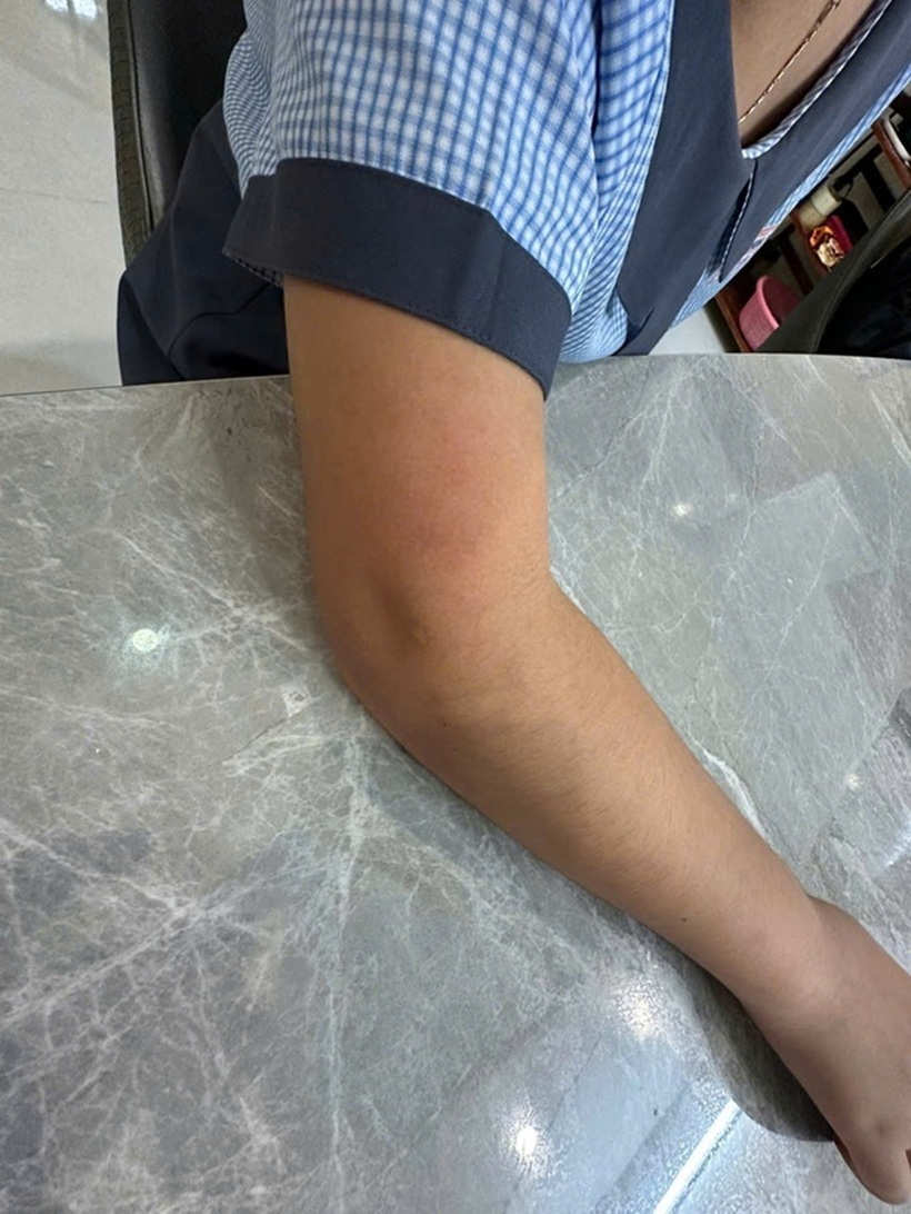 Vết đỏ trên cánh tay em T. được phụ huynh phát hiện vào tối 19/3. Ảnh: Thanh niên