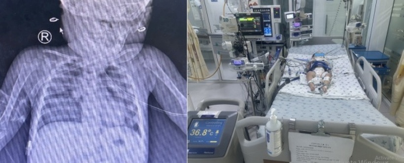 Bé gái 14 tháng tuổi ngưng tim, ngưng thở sau khi ngã vào thùng nước. Ảnh: BVCC.