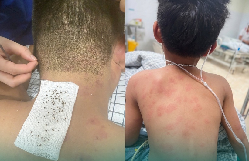Đi tìm tổ chim, hai cha con bị ong mật đốt với hơn 300 vết đốt. Ảnh: Báo Dân việt.
