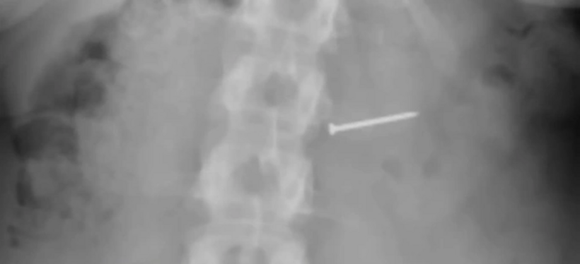 Hình ảnh chụp X quang của Brandy Buckley. Ảnh: NYPost