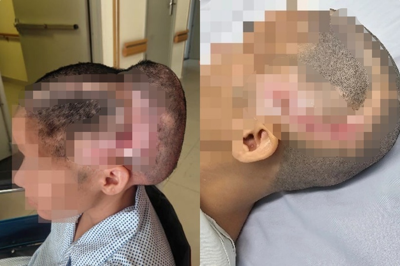Bệnh nhân trước và sai khi phẫu thuật. Ảnh: Báo Dân việt.