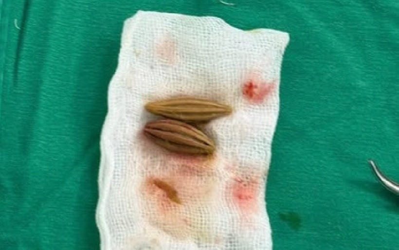 Cấp cứu cụ bà thủng trực tràng do nuốt nhầm hạt nhót. Ảnh: Báo Sức khỏe và Đời sống.