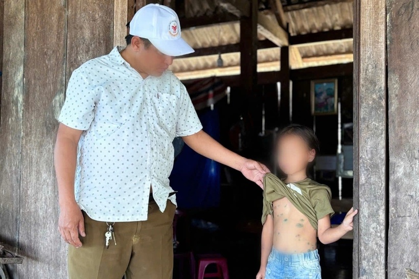 23 học sinh được phát hiện mắc thủy đậu tại một điểm trường. Ảnh: Dân trí