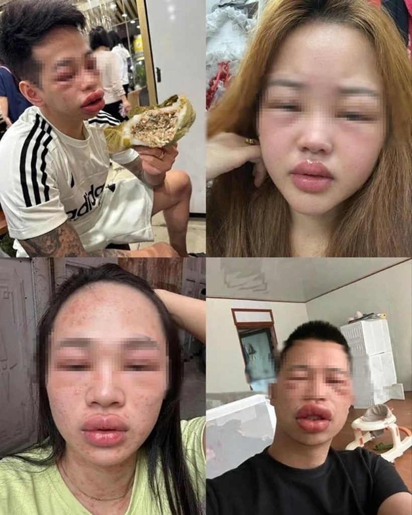 Nhiều người sưng phù mặt sau khi ăn bánh trứng kiến. Ảnh: Gia đình Việt Nam