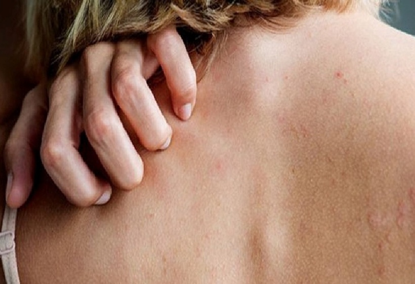 Ngứa do suy thận không đơn thuần là bệnh ngoài da mà là biểu hiện của tình trạng “nhiễm độc” từ bên trong cơ thể.