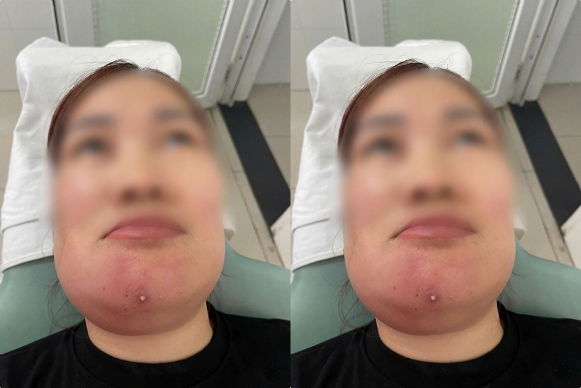 Vùng cằm và dưới hàm hai bên sưng nóng, đỏ, ấn đau, có điểm hóa mủ. Ảnh: BVCC.