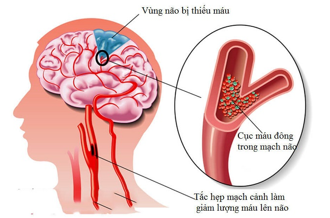 Tai biến mạch máu não gây tổn thương tế bào thần kinh rất nhanh chỉ trong vài phút