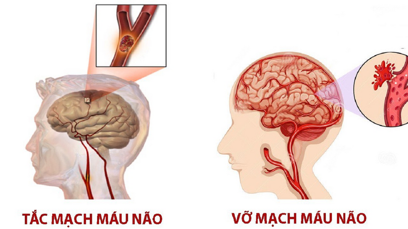 Hai dạng tai biến mạch máu não gồm nhồi máu não và xuất huyết não