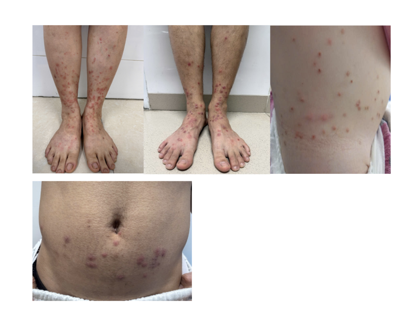 Nhiều bệnh nhân bị bọ chét cắn trong mùa nóng ẩm. Ảnh: BVCC