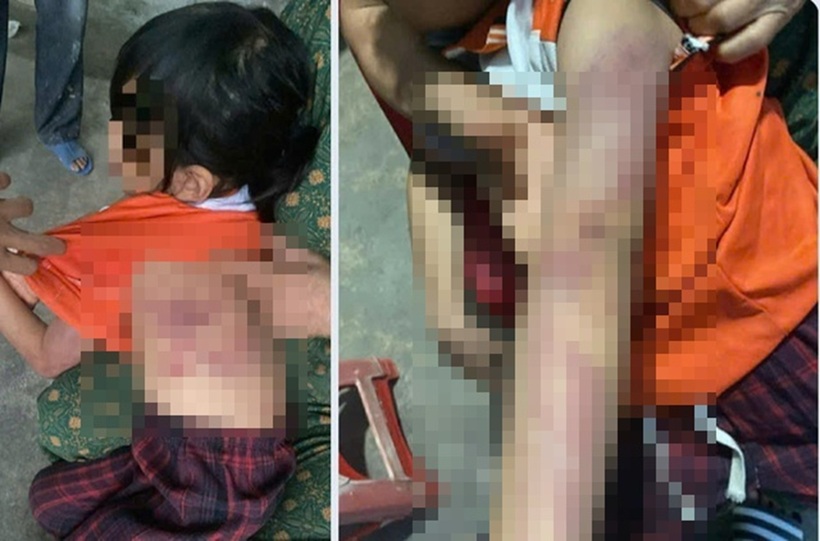Vết bầm tím trên người cháu bé. Ảnh: Sức khỏe & Đời sống