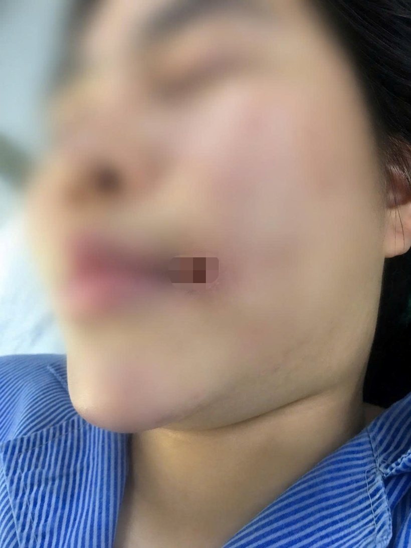 Người bệnh nhiễm trùng vùng mặt do biến chứng do tiêm filler. Ảnh: BVCC.