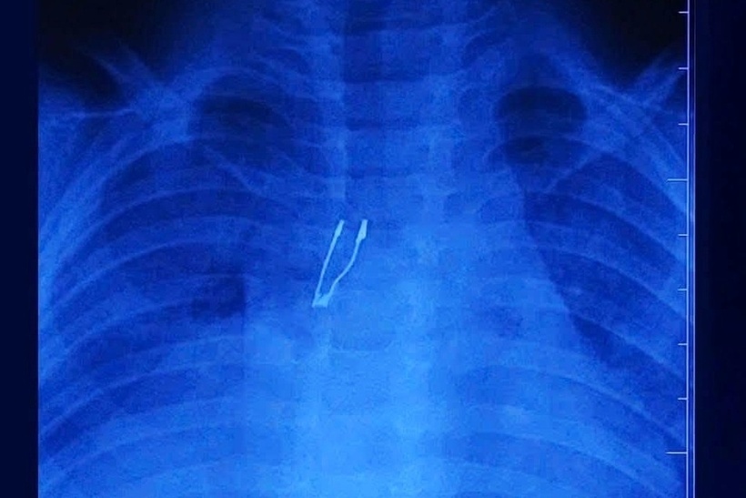 Dị vật nghi ngờ là một bóng đèn LED, nằm sâu trong phế quản gốc phải. Ảnh: Pháp luật TP.HCM