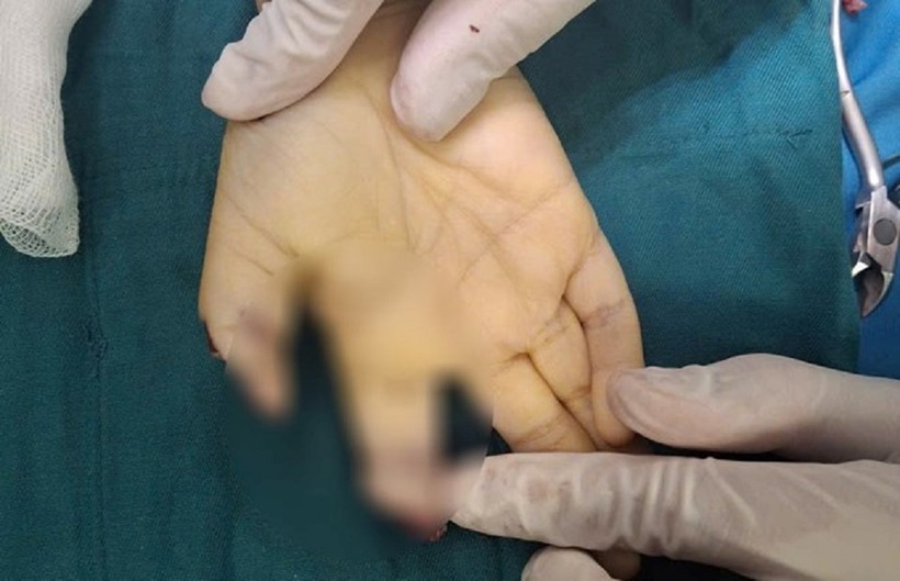 Bé trai 5 tuổi đứt lìa 2 ngón tay khi chơi xe điện tự chế. Ảnh: BVCC
