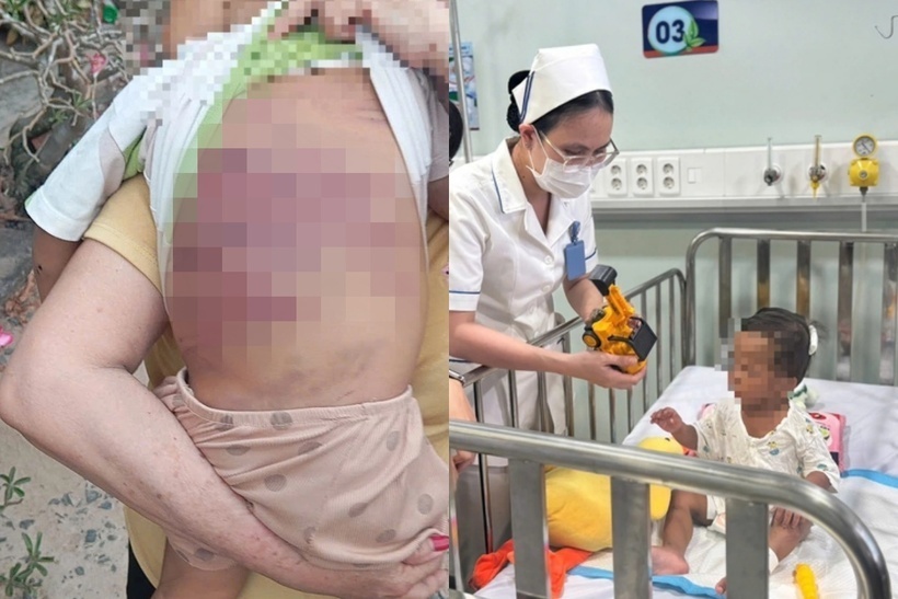 Vụ việc tại TP HCM khiến bé trai 2 tuổi tổn thương nghiêm trọng