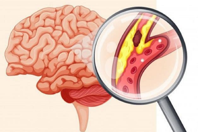 Nhồi máu não xảy ra khi mạch máu bị tắc khiến não thiếu oxy và dưỡng chất