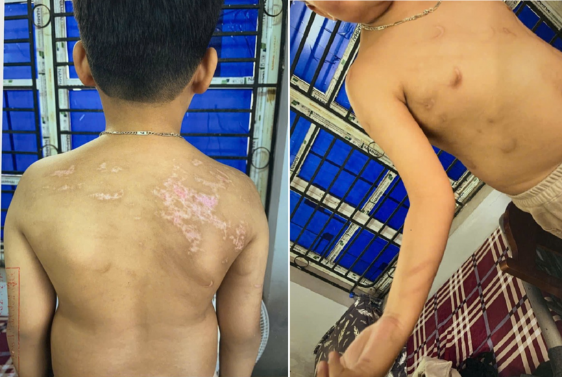 Hình ảnh thương tích của cháu N. Đ. B. K. sau khi bị Nguyễn Hà Chung đánh gây thương tích. (Ảnh: Bộ Công an)