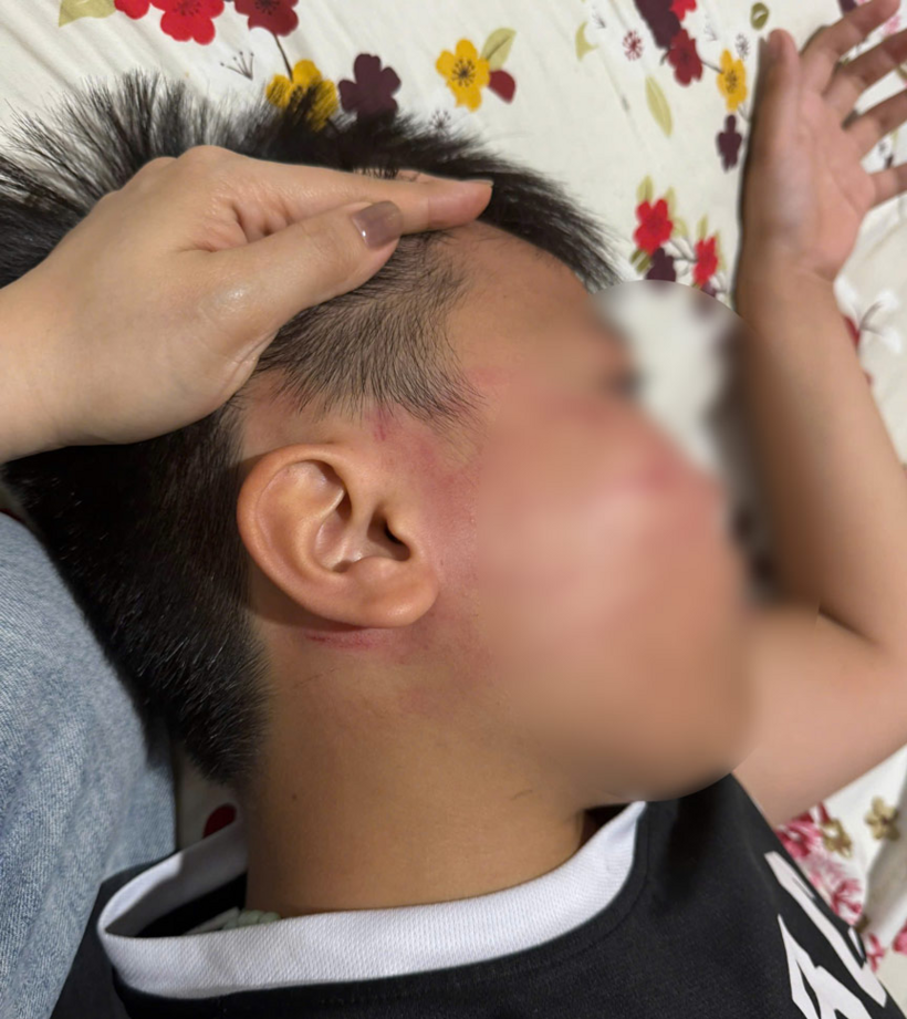 Vùng má, tai cháu V. xuất hiện nhiều vết bầm đỏ. Ảnh: Gia đình cung cấp/Lao Động