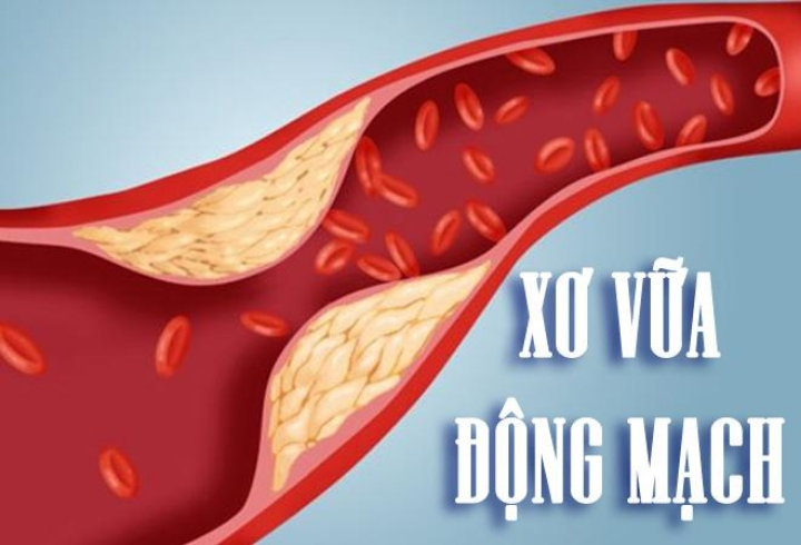 Xơ vữa động mạch là một trong những nguyên nhân chính gây ra tai biến mạch máu não