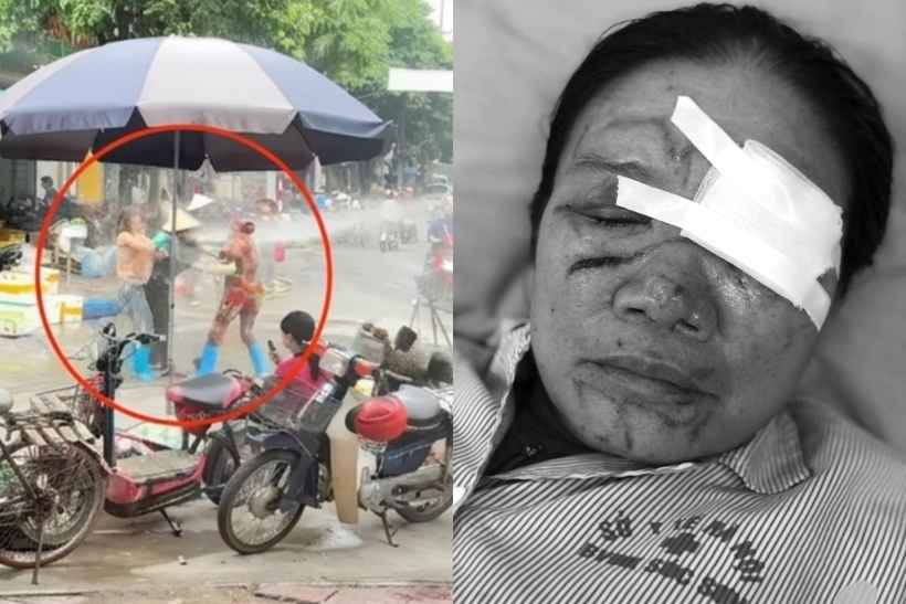 Tình trạng hiện nay của bệnh nhân vẫn chưa thể xác định mức độ ảnh hưởng lâu dài đến thị lực.