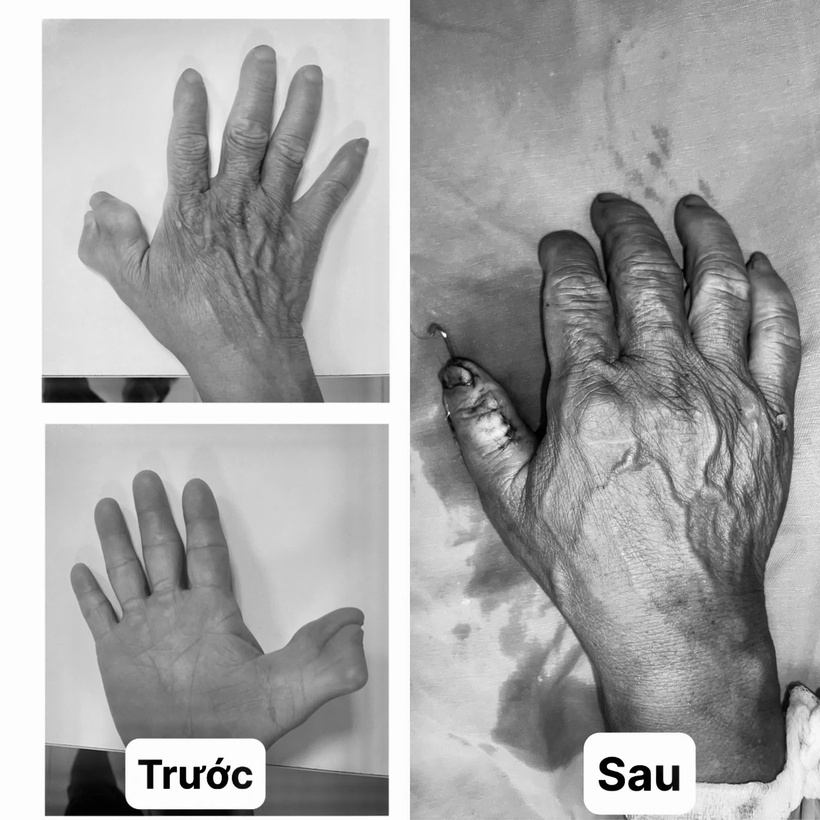 Người đàn ông mang dị tật thừa ngón suốt 58 năm (ảnh bên trái). Ảnh: BVCC