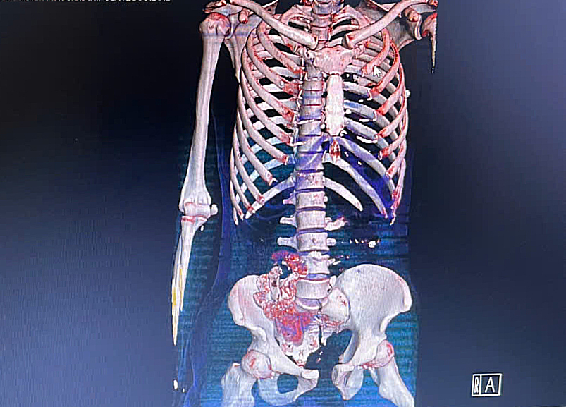 Phim chụp dựng hình 3D các chấn thương phức tạp của người bệnh. Ảnh: BVCC