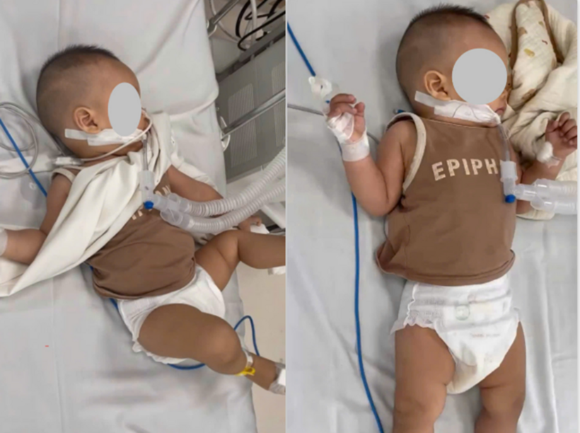 Em bé đã được các bác sĩ nhi khoa tại Bệnh viện Bạch Mai cơ sở Ninh Bình cấp cứu kịp thời và qua cơn nguy kịch. Ảnh: Bệnh viện Bạch Mai