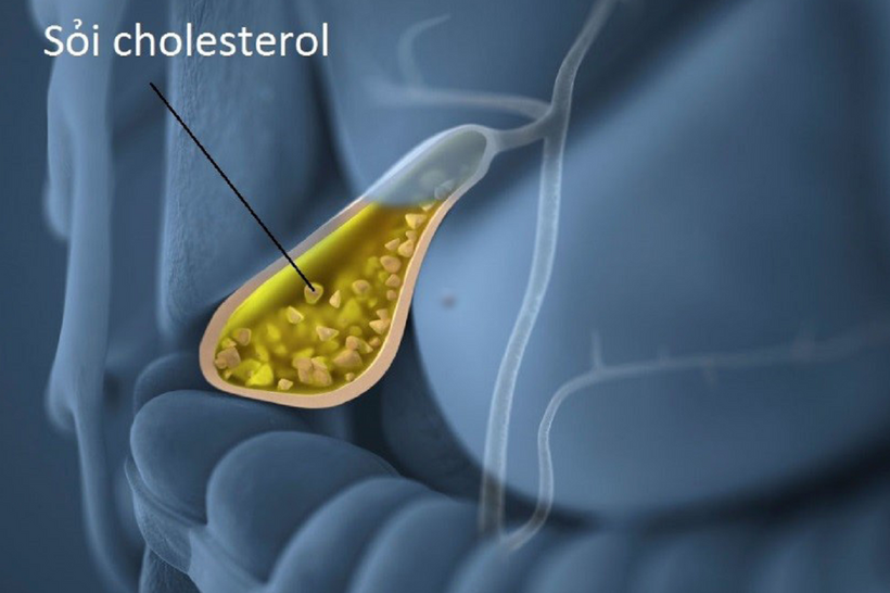 Sỏi cholesterol thường liên quan đến rối loạn chuyển hóa và chế độ ăn uống.